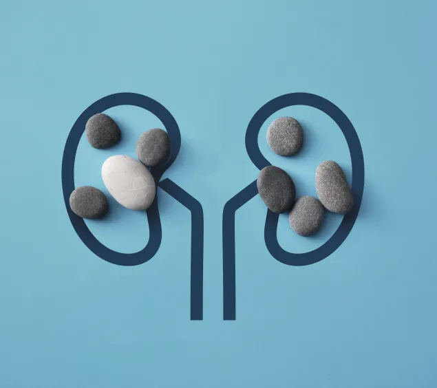 Nierensteine