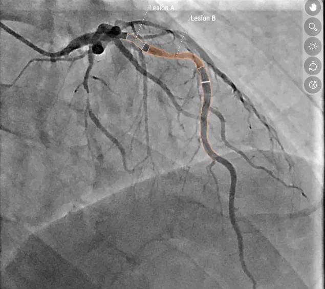 Bildaufnahme einer Engstelle der Vorderwand des Herzens