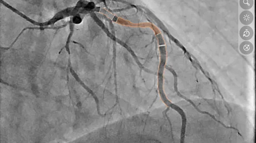 Bildaufnahme einer Engstelle der Vorderwand des Herzens
