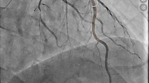 Darstellung von Engstellen an der Vorderwand des Herzens