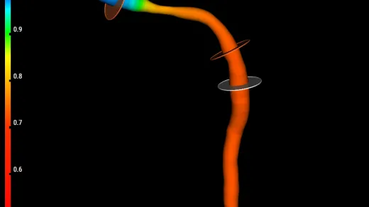 KI-Darstellung von Engstellen an der Vorderwand des Herzens