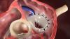 Implantation Herzklappenring / Cardioband